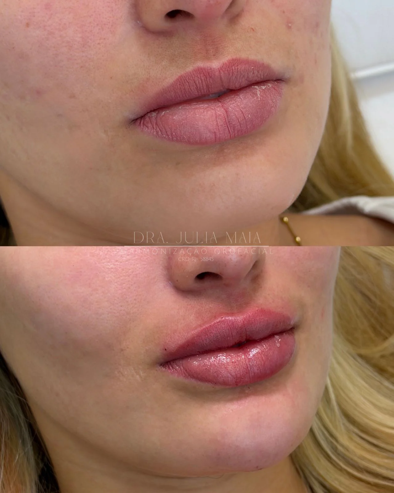 Preenchimento labial com contorno, volume e hidratação after
