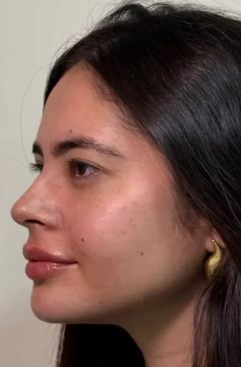 Perfil transformado com a perfiloplastia after