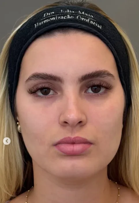 Full face com preenchimento labial before