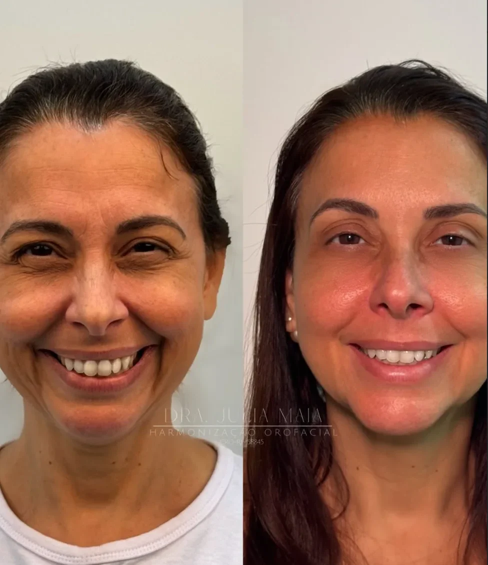 Tratamento pra rugas e qualidade de pele after