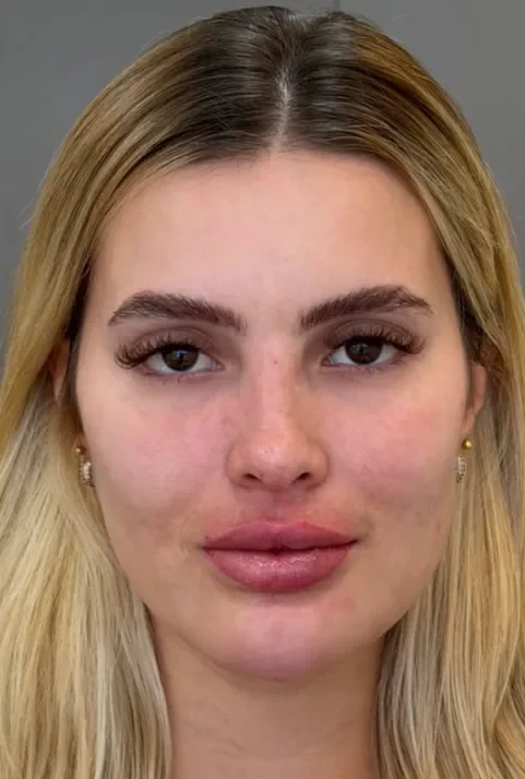 Full face com preenchimento labial after