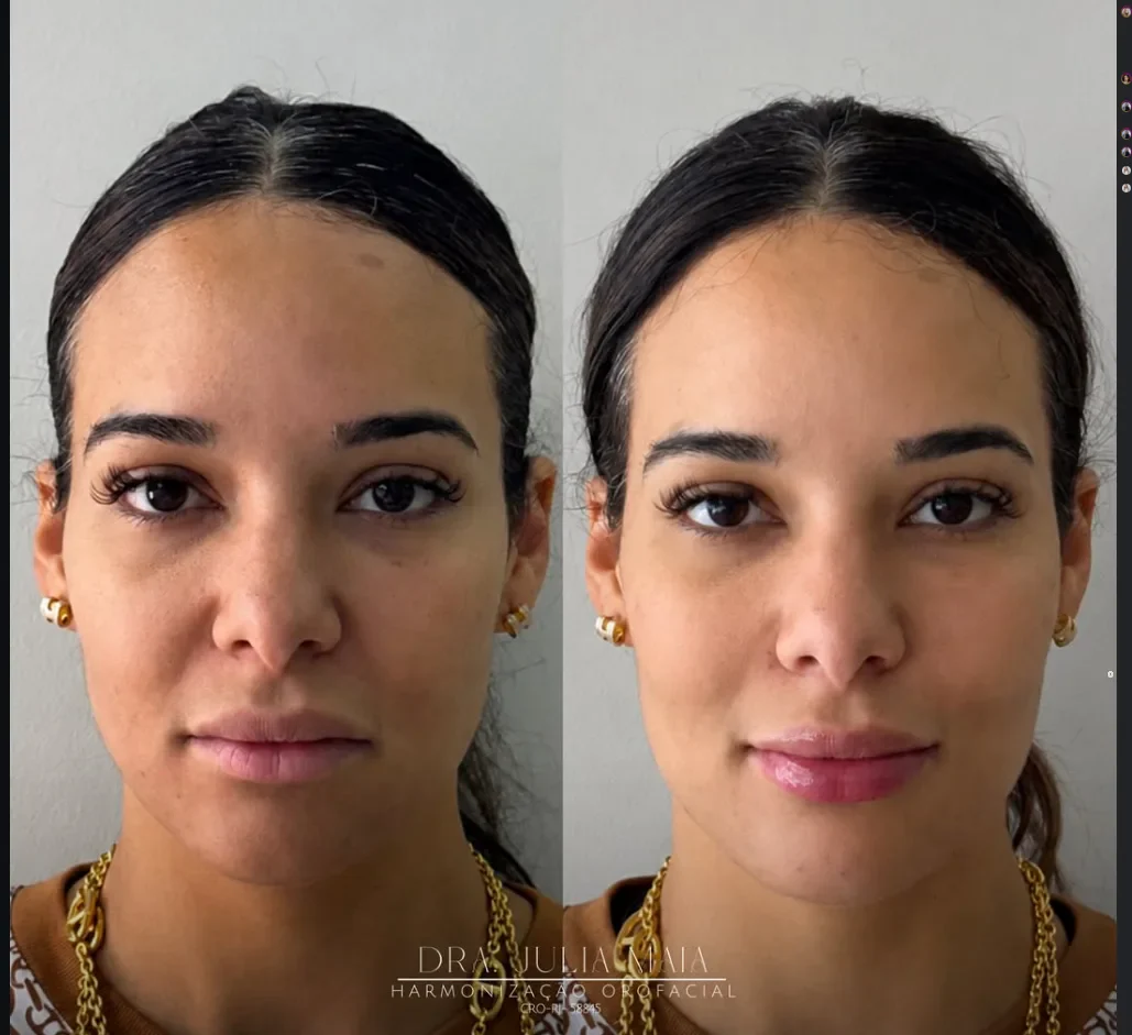 Rejuvenescimento Facial com Full Face after