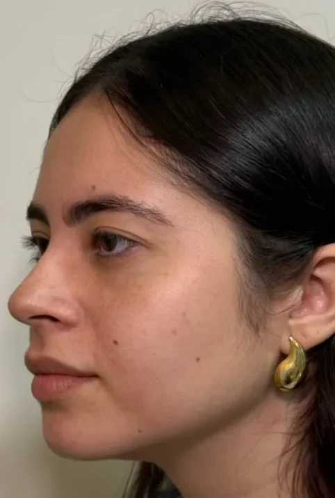 Perfil transformado com a perfiloplastia before
